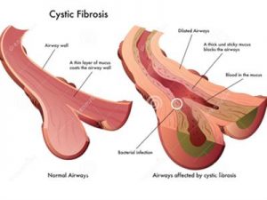 U xơ nang - Hình ảnh minh họa